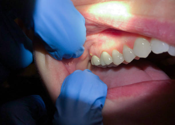 Best Emergency Dentist for Lost Fillings or Crowns in Dexter, NM