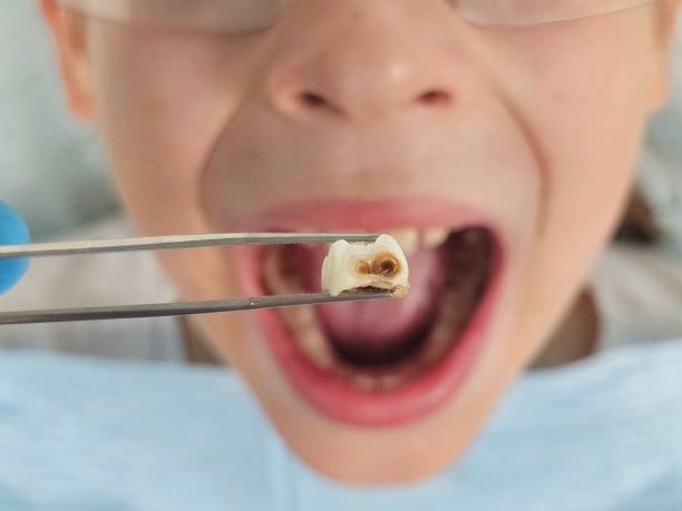 Best Emergency Dental Extractions in Dexter, NM